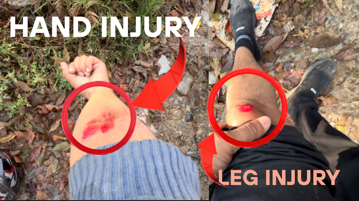 I Have Minor Injuries On My Hands And Feet After An Accident In Syangja